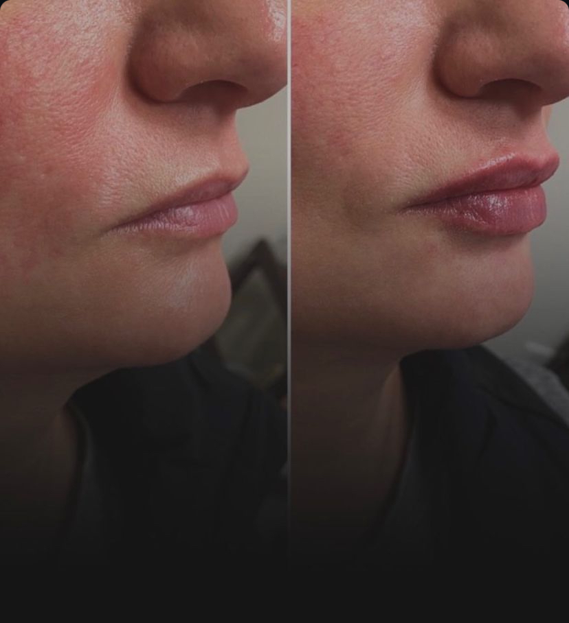 Hyamax Augmenta L-Plus
